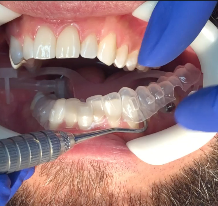 Ormco Spark™ Innovative & Advanced Clear Aligner System