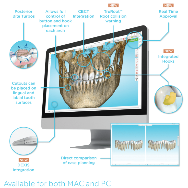 Ormco Spark™ Innovative & Advanced Clear Aligner System