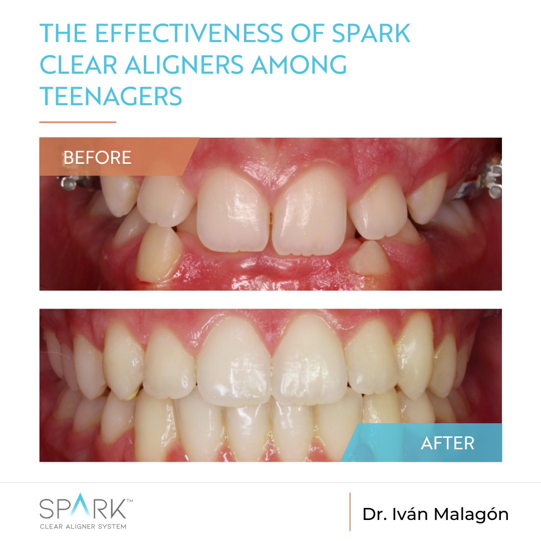 Case report | Spark Clear Aligners - Effective Treatment Among ...