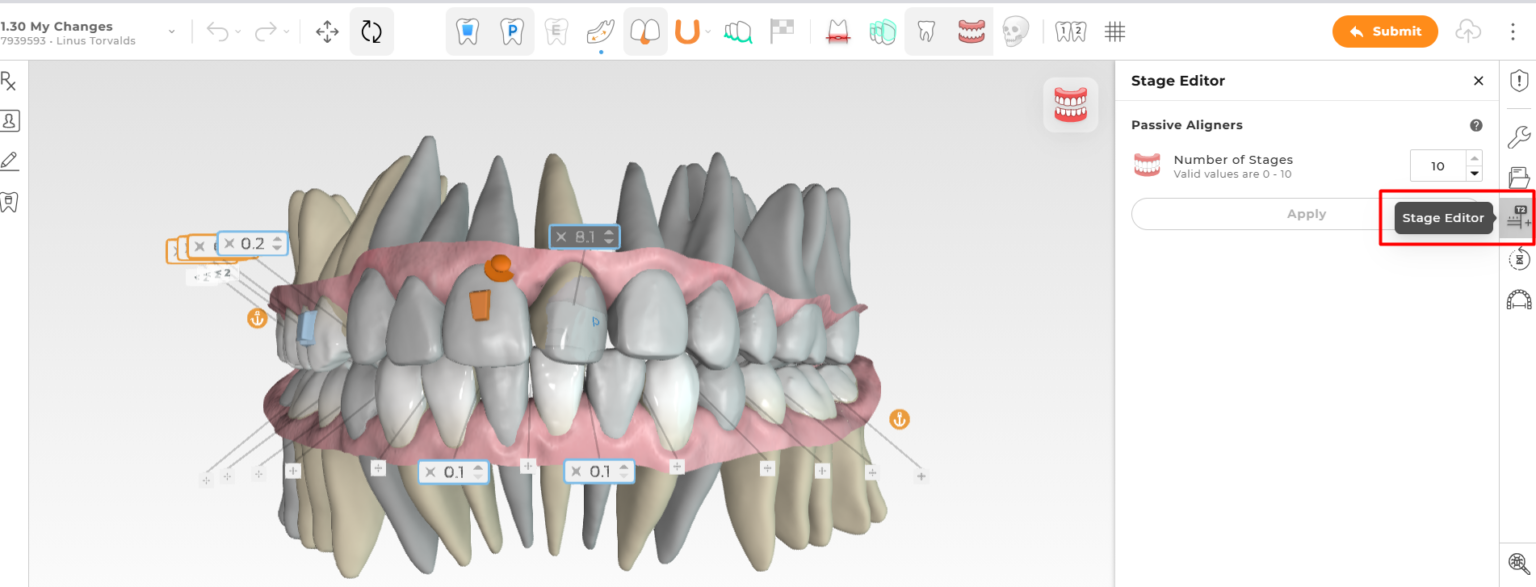 Ormco - Spark™ Releases - Latest Updates on Spark Aligners